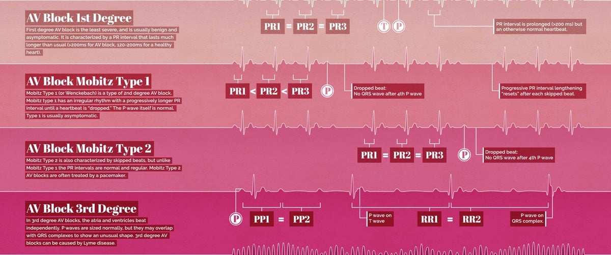 Abnormal EKG